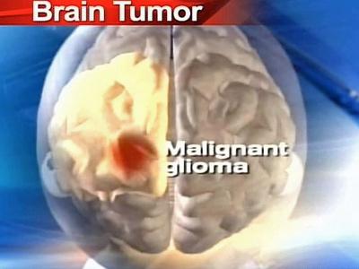 Malignant Brain Tumours & Mobile Phones